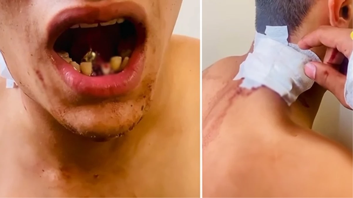 17 yaşındaki genç dondurma almaya giderken ölüyordu! Boynundan giren kurşun çenesine saplandı