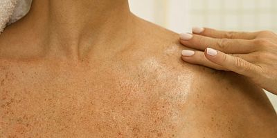 Cildinizde renk değişiklikleri varsa yaz mantarı olabilir